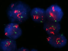 An image of breast cancer cells with strong HER2 amplification.