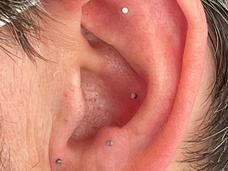 An image of a man's ear with several acupuncture studs placed in it.