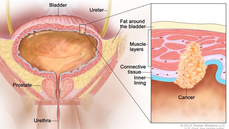 Drawing of stage II bladder cancer, also known as muscle-invasive bladder cancer. An inset shows cancer in the inner lining of the bladder and in the layer of connective tissue and the muscle layers of the bladder.